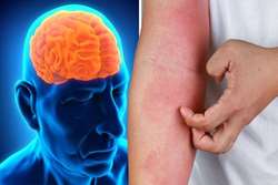 خطر ابتلا به اختلالات شناختی در بین کودکان مبتلا به درماتیت آتوپیک (AD) 