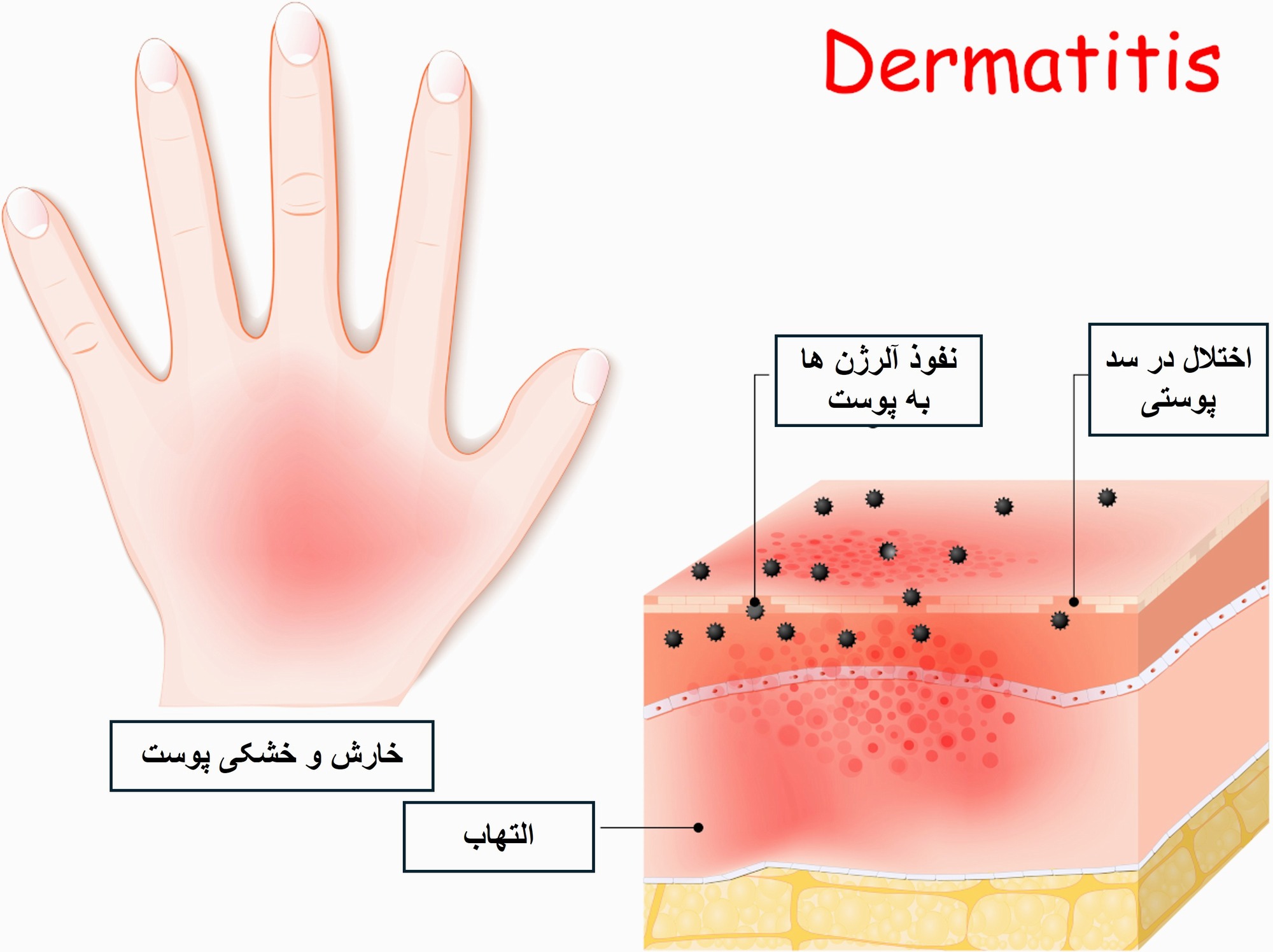 مهار IL‑22؛ گامی نو در بازسازی سد پوستی و کنترل التهاب در AD